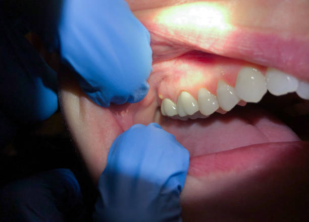 Best Knocked-Out Tooth (Avulsed Tooth) Treatment in Cienegas Terrace, TX